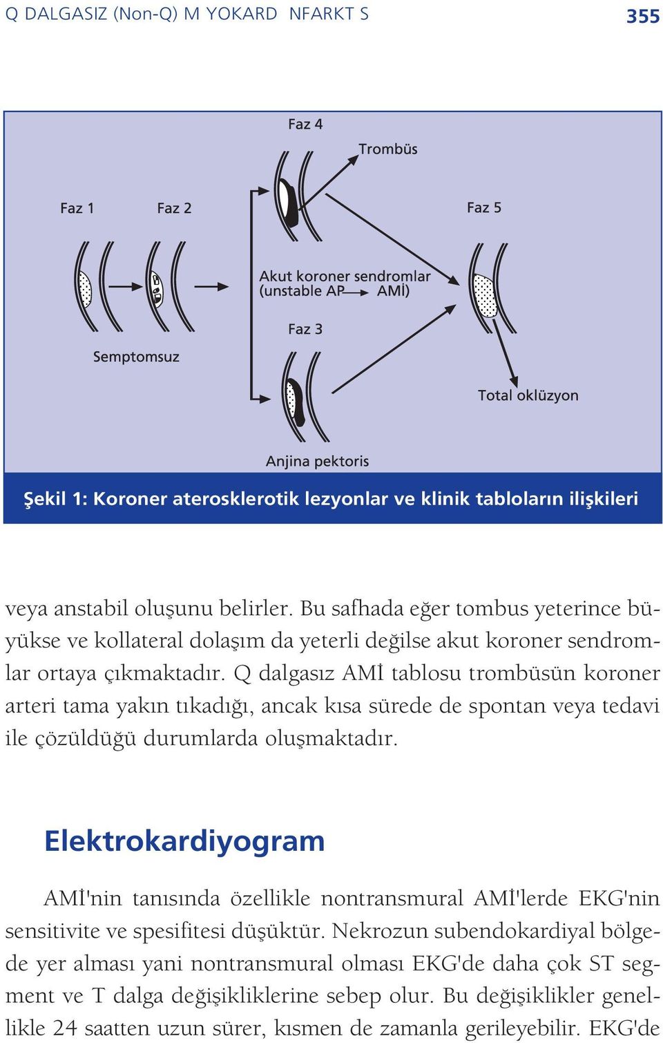 Q dalgas z AM tablosu trombüsün koroner arteri tama yak n t kad, ancak k sa sürede de spontan veya tedavi ile çözüldü ü durumlarda oluflmaktad r.