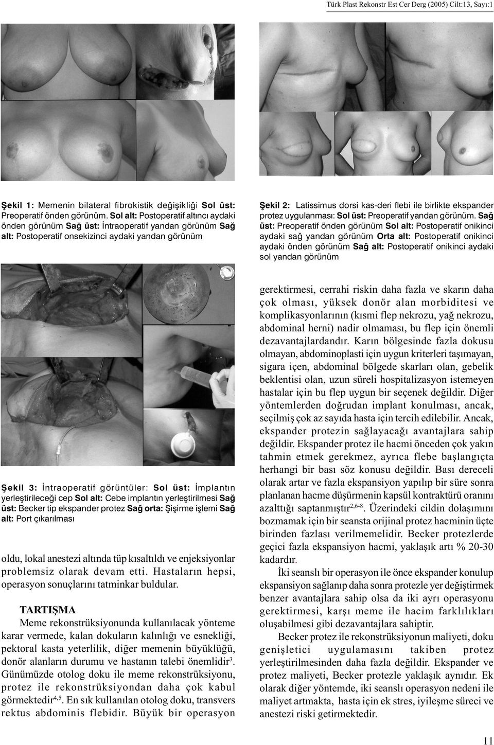 ekspander protez uygulanmasý: Sol üst: Preoperatif yandan görünüm.