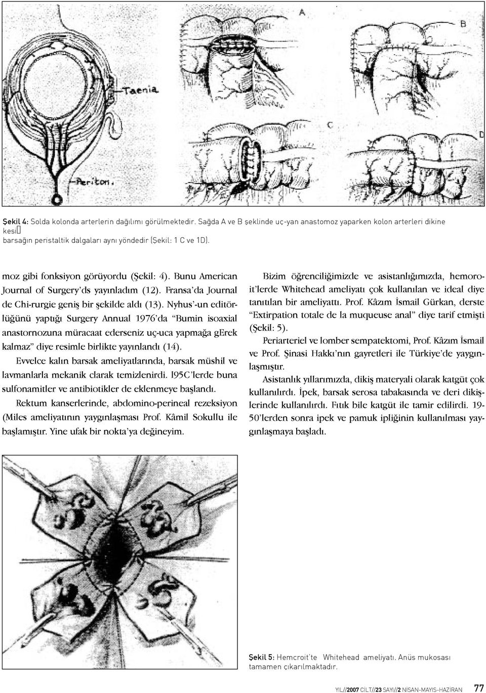 Nyhus -un editörlüğünü yaptığı Surgery Annual 1976 da Bumin isoaxial anastornozuna müracaat ederseniz uç-uca yapmağa gerek kalmaz diye resimle birlikte yayınlandı (14).