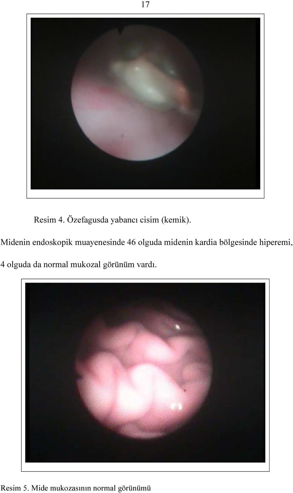 kardia bölgesinde hiperemi, 4 olguda da normal