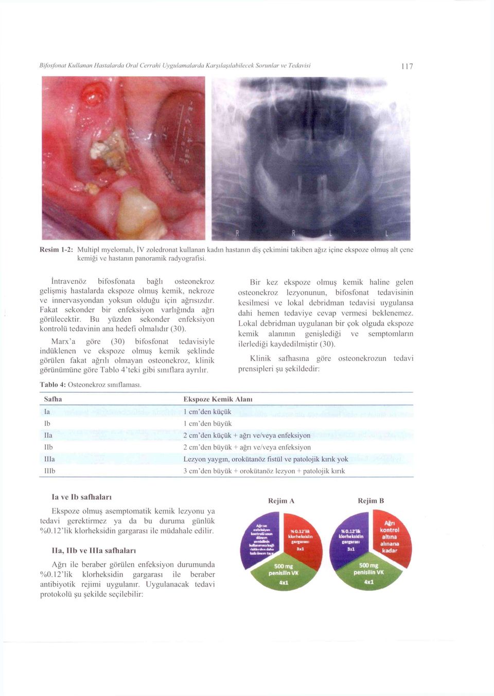 İntravenöz bifosfonata bağlı osteonekroz gelişmiş hastalarda ekspoze olmuş kemik, nekroze ve innervasyondan yoksun olduğu için ağrısızdır. Fakat sekonder bir enfeksiyon varlığında ağrı görülecektir.