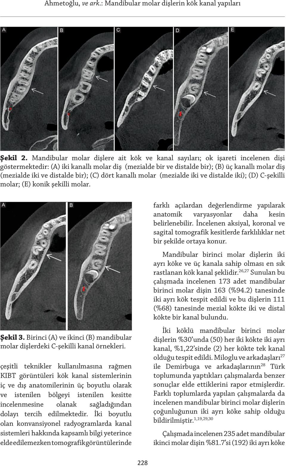 distalde bir); (C) dört kanallı molar (mezialde iki ve distalde iki); (D) C-şekilli molar; (E) konik şekilli molar. A Şekil 3.