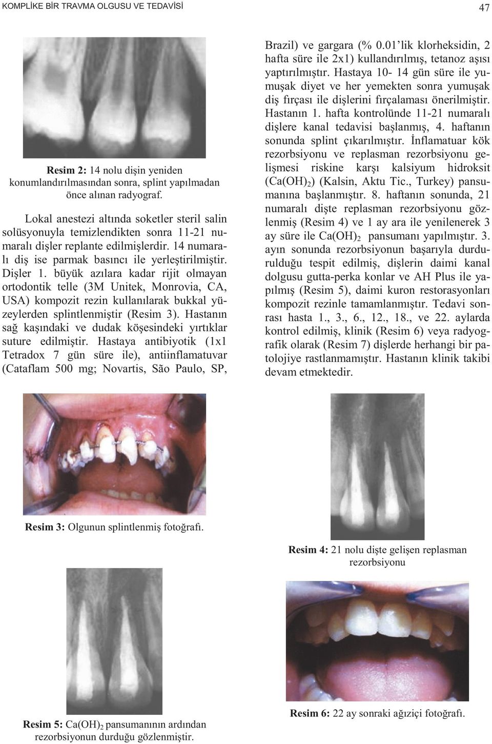 büyük azılara kadar rijit olmayan ortodontik telle (3M Unitek, Monrovia, CA, USA) kompozit rezin kullanılarak bukkal yüzeylerden splintlenmiştir (Resim 3).