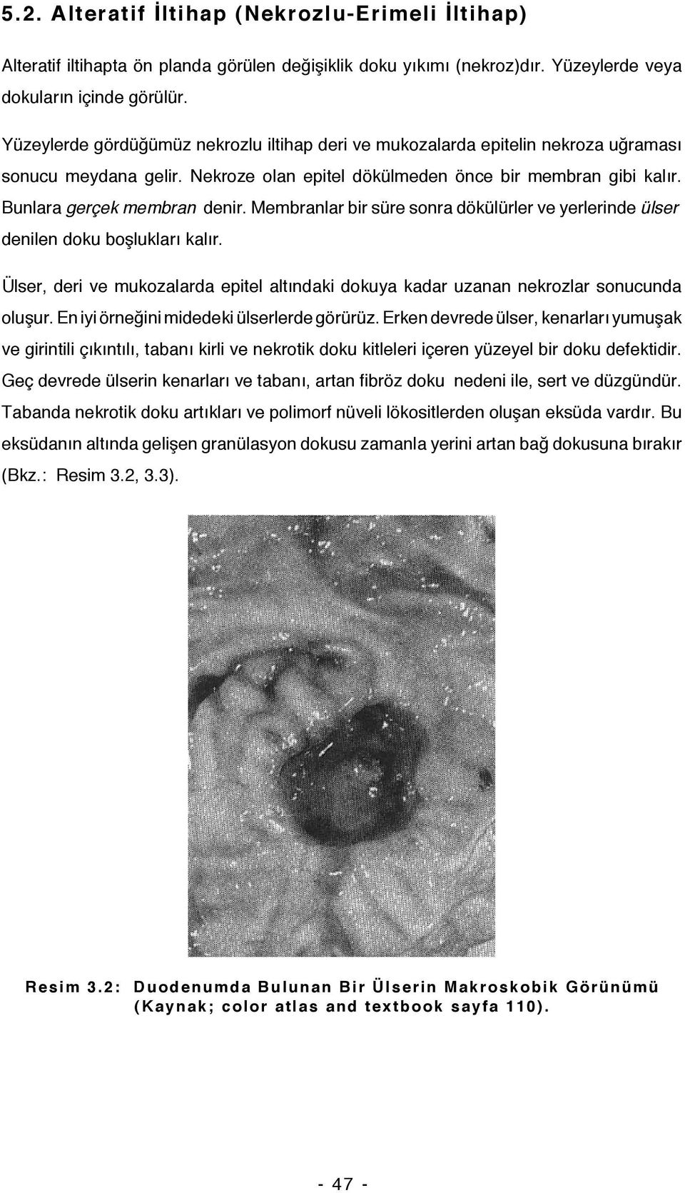 Membranlar bir süre sonra dökülürler ve yerlerinde ülser denilen doku boşlukları kalır. Ülser, deri ve mukozalarda epitel altındaki dokuya kadar uzanan nekrozlar sonucunda oluşur.