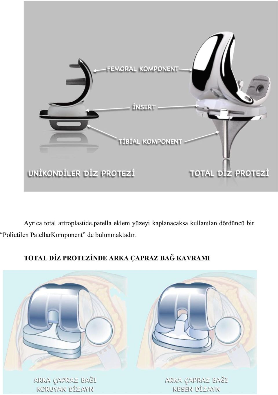 Polietilen PatellarKomponent de