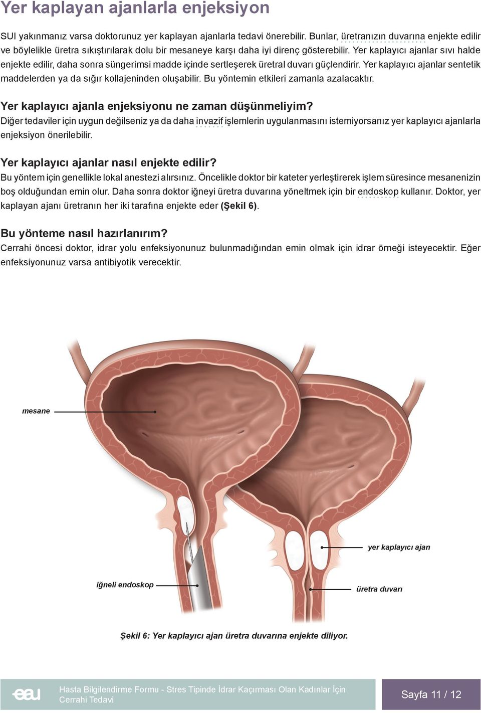 Yer kaplayıcı ajanlar sıvı halde enjekte edilir, daha sonra süngerimsi madde içinde sertleşerek üretral duvarı güçlendirir.