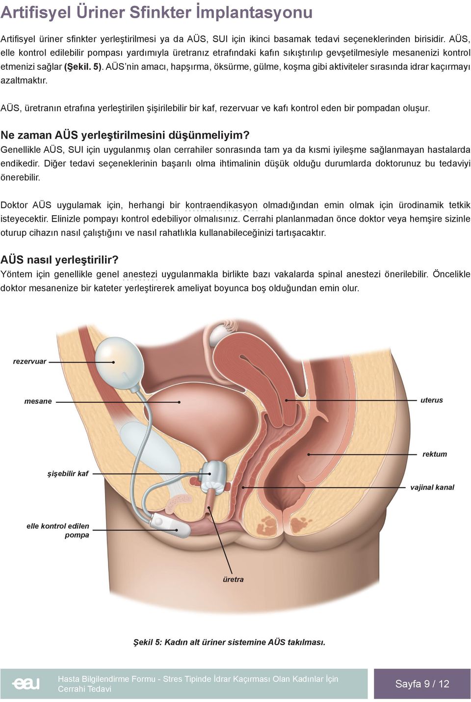 AÜS nin amacı, hapşırma, öksürme, gülme, koşma gibi aktiviteler sırasında idrar kaçırmayı azaltmaktır.