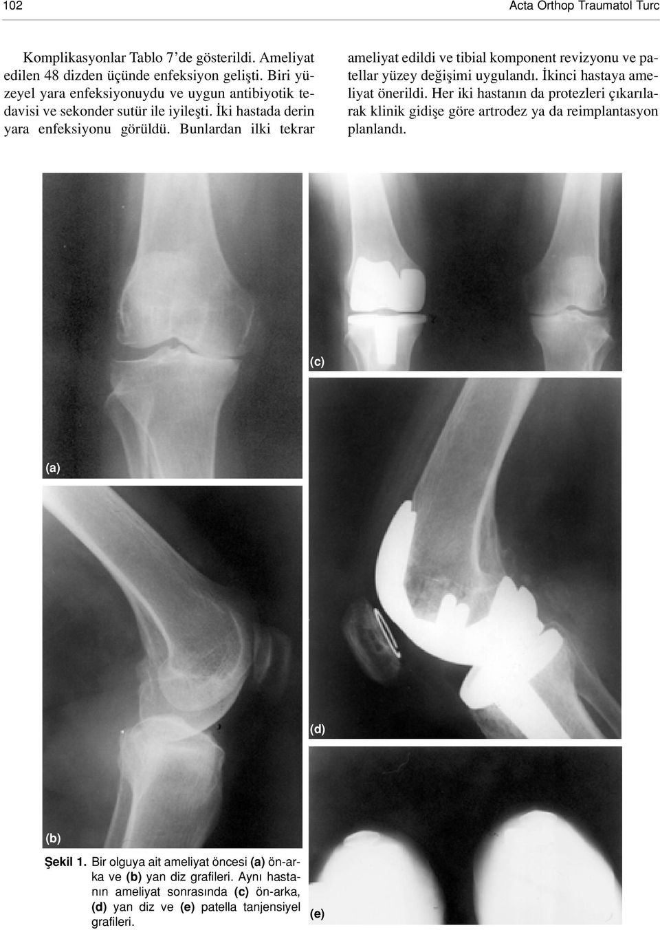 Bunlardan ilki tekrar ameliyat edildi ve tibial komponent revizyonu ve patellar yüzey de iflimi uyguland. kinci hastaya ameliyat önerildi.