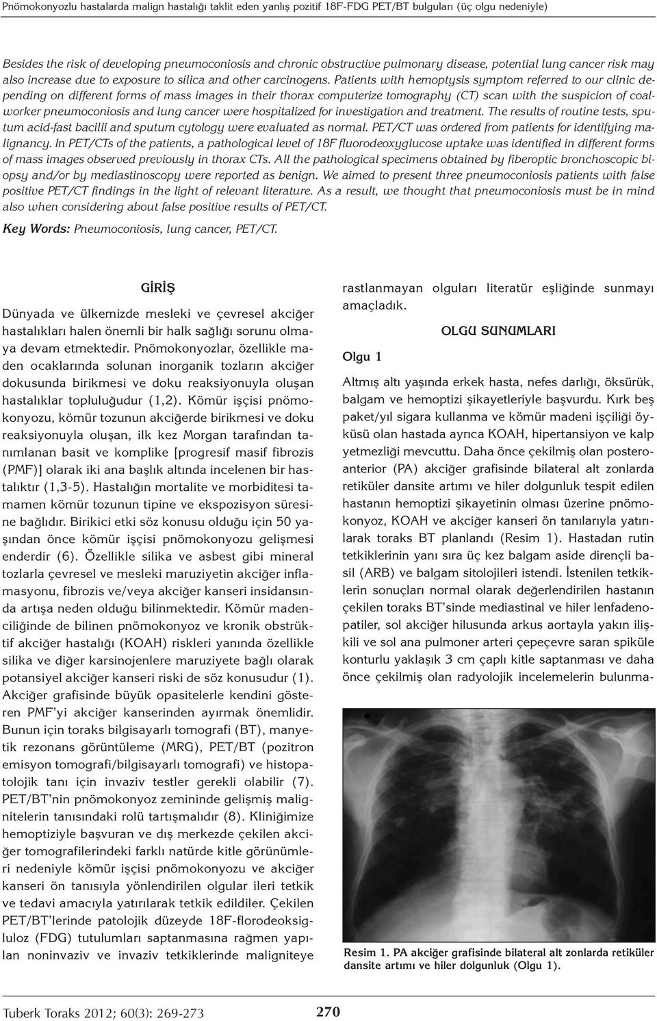 Patients with hemoptysis symptom referred to our clinic depending on different forms of mass images in their thorax computerize tomography (CT) scan with the suspicion of coalworker pneumoconiosis
