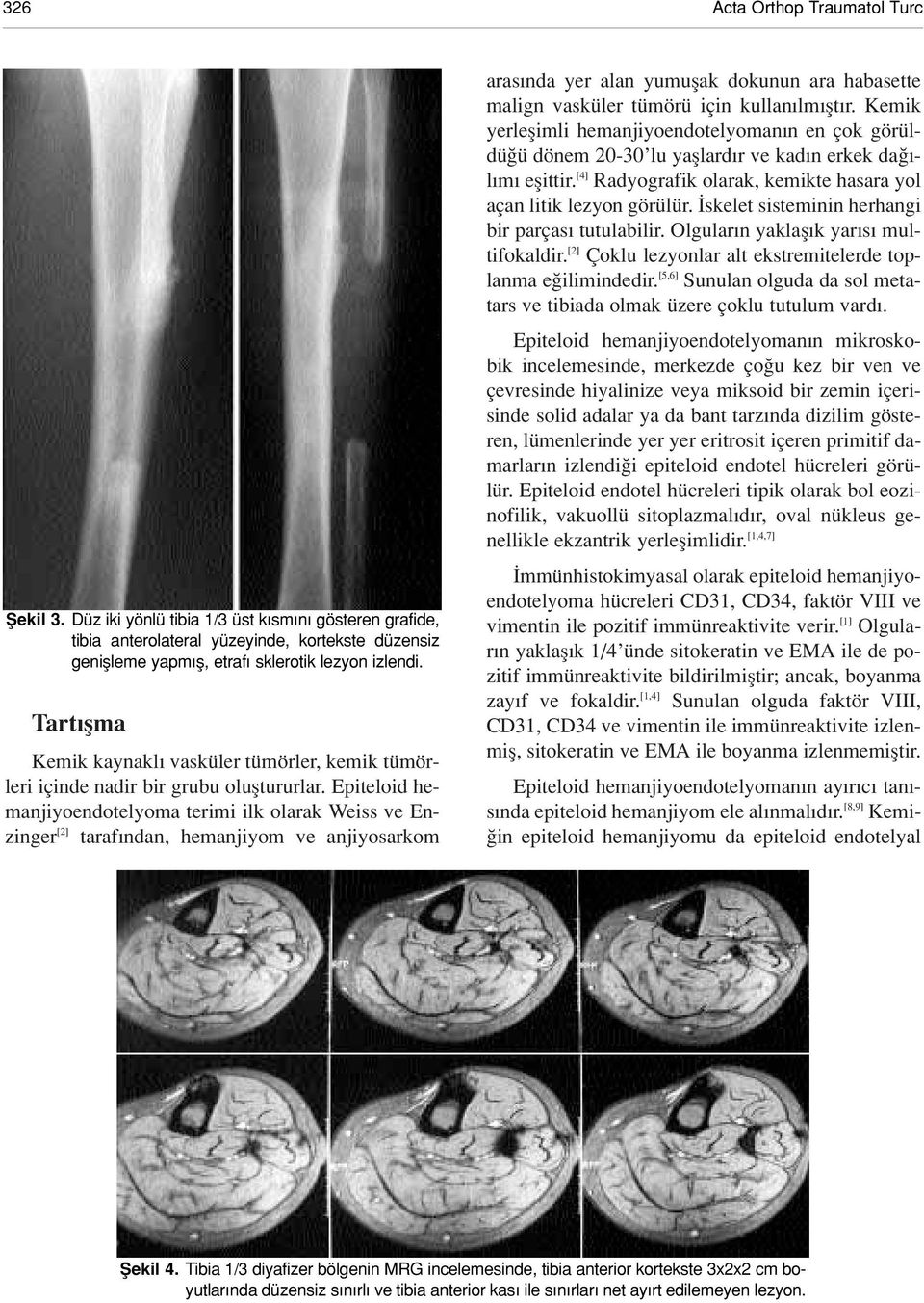 Epiteloid hemanjiyoendotelyoma terimi ilk olarak Weiss ve Enzinger [2] taraf ndan, hemanjiyom ve anjiyosarkom aras nda yer alan yumuflak dokunun ara habasette malign vasküler tümörü için kullan lm