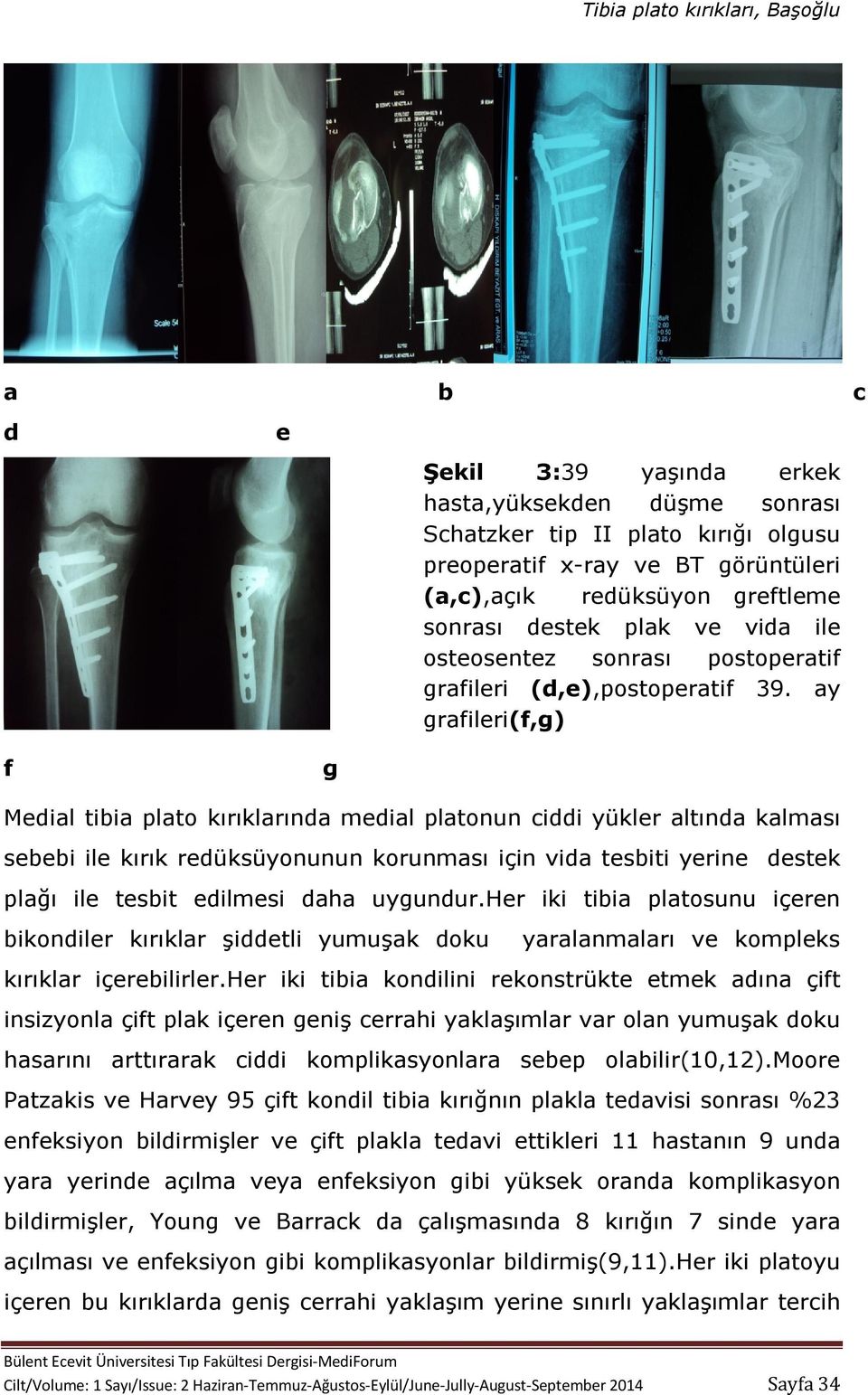 ay grafileri(f,g) f g Medial tibia plato kırıklarında medial platonun ciddi yükler altında kalması sebebi ile kırık redüksüyonunun korunması için vida tesbiti yerine destek plağı ile tesbit edilmesi