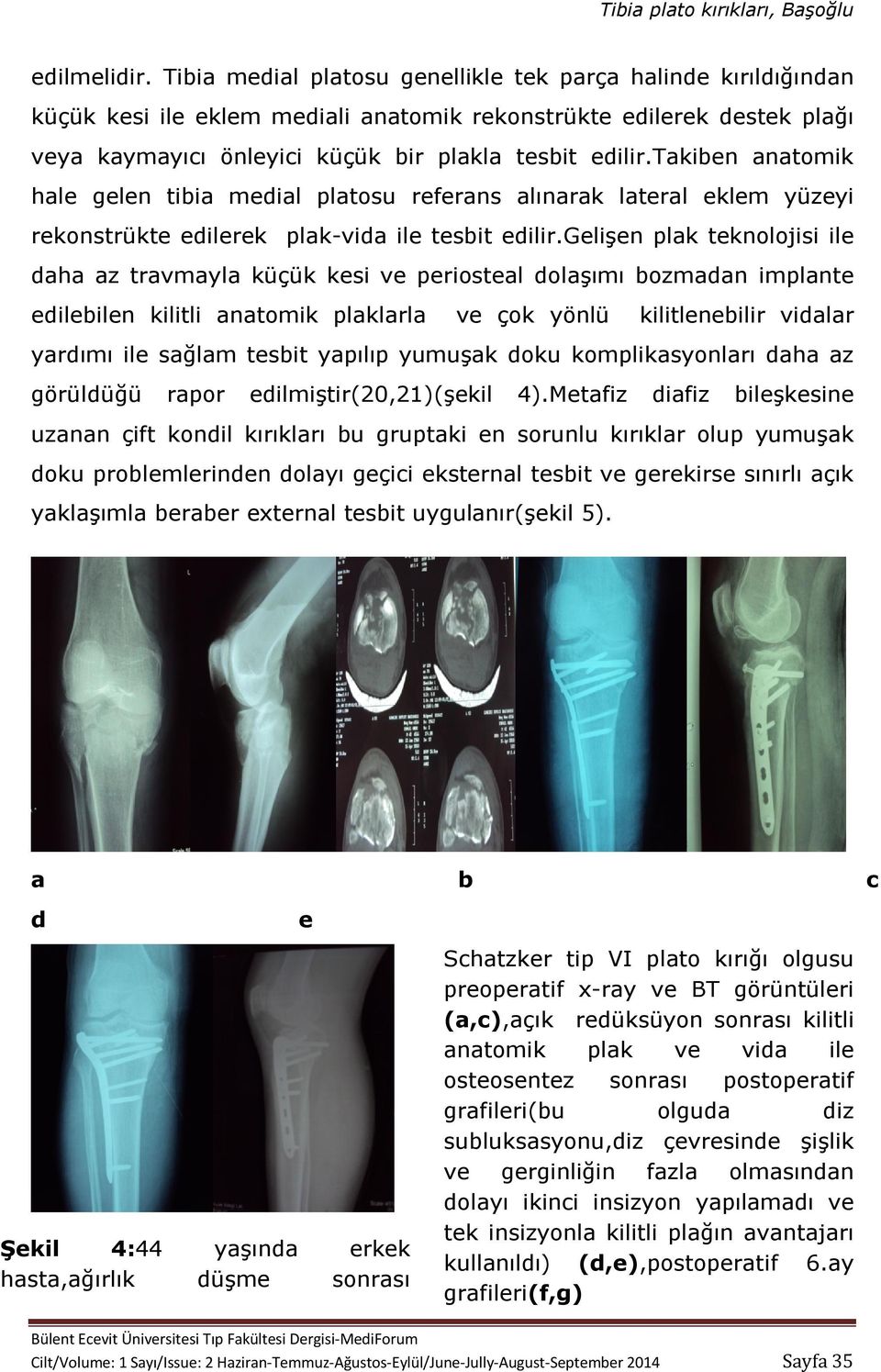 takiben anatomik hale gelen tibia medial platosu referans alınarak lateral eklem yüzeyi rekonstrükte edilerek plak-vida ile tesbit edilir.