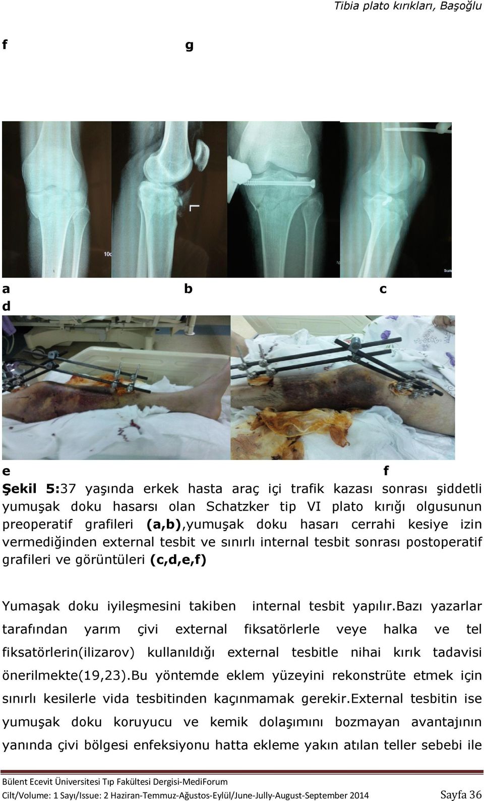 bazı yazarlar tarafından yarım çivi external fiksatörlerle veye halka ve tel fiksatörlerin(ilizarov) kullanıldığı external tesbitle nihai kırık tadavisi önerilmekte(19,23).