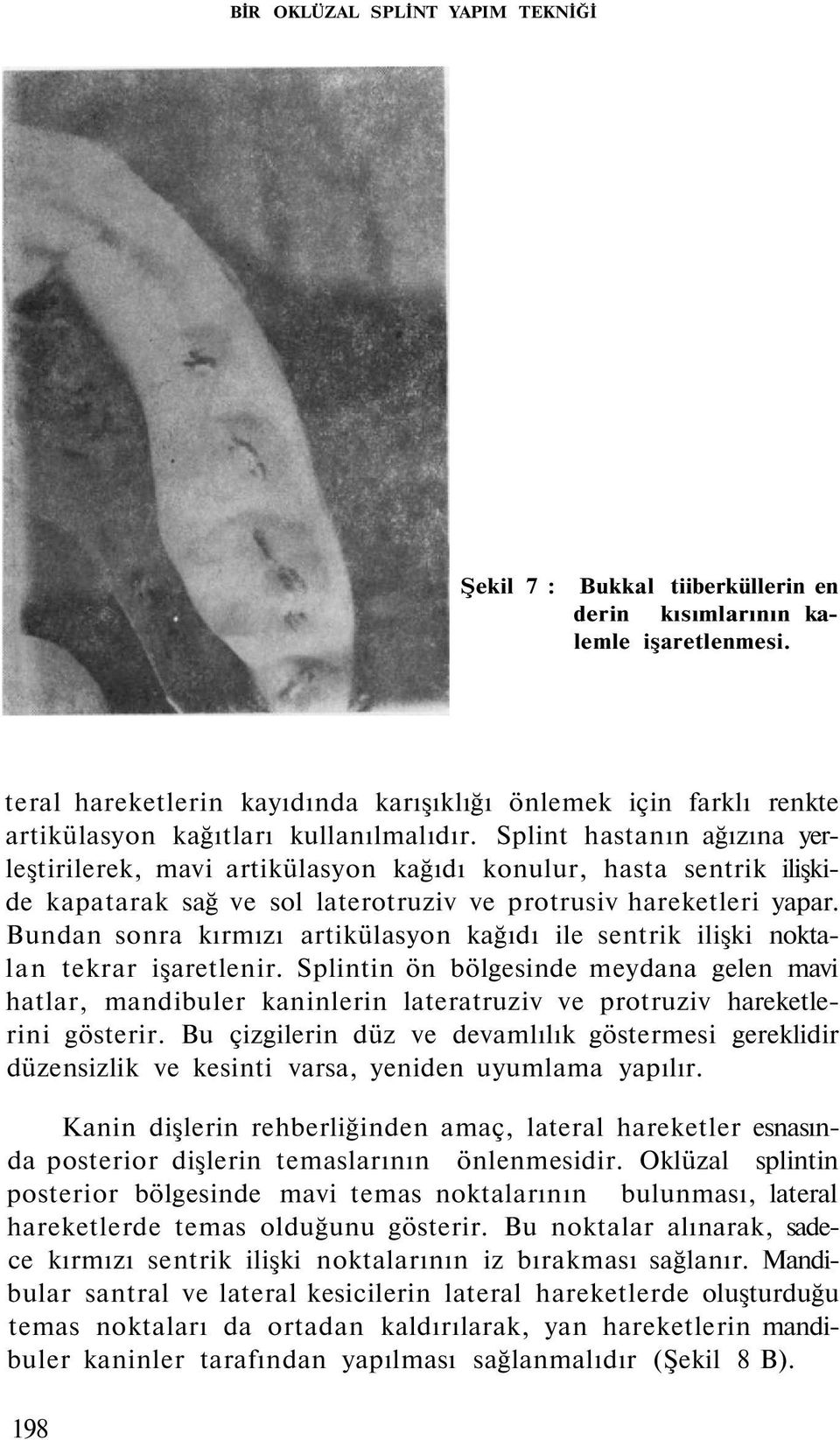 Splint hastanın ağızına yerleştirilerek, mavi artikülasyon kağıdı konulur, hasta sentrik ilişkide kapatarak sağ ve sol laterotruziv ve protrusiv hareketleri yapar.