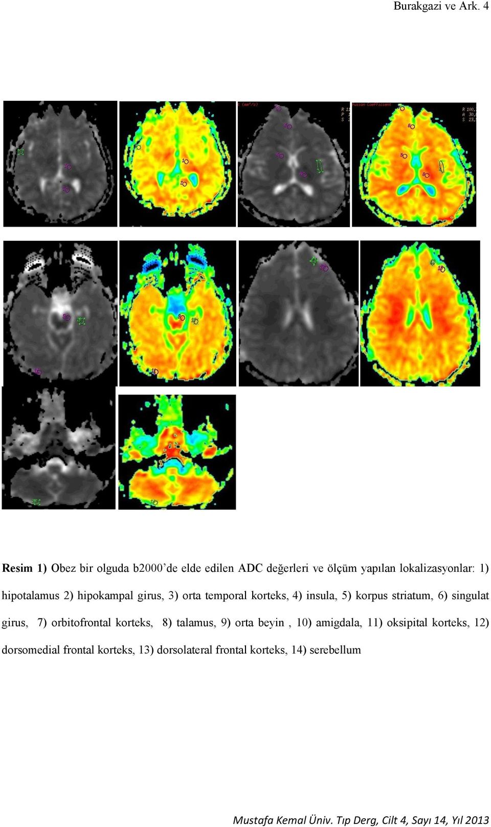 hipotalamus 2) hipokampal girus, 3) orta temporal korteks, 4) insula, 5) korpus striatum, 6)