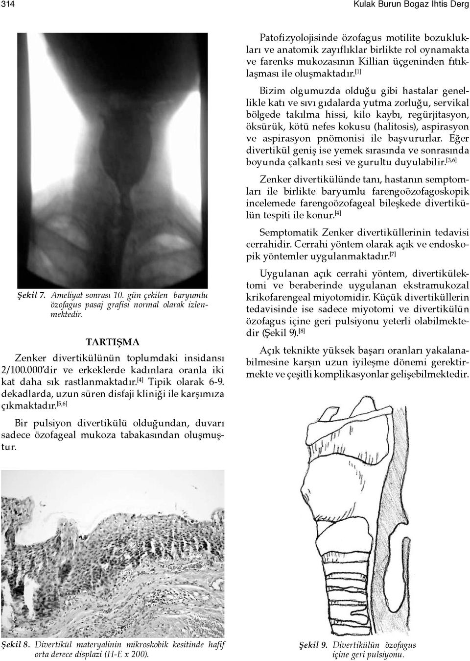 [5,6] Bir pulsiyon divertikülü olduğundan, duvarı sadece özofageal mukoza tabakasından oluşmuştur.