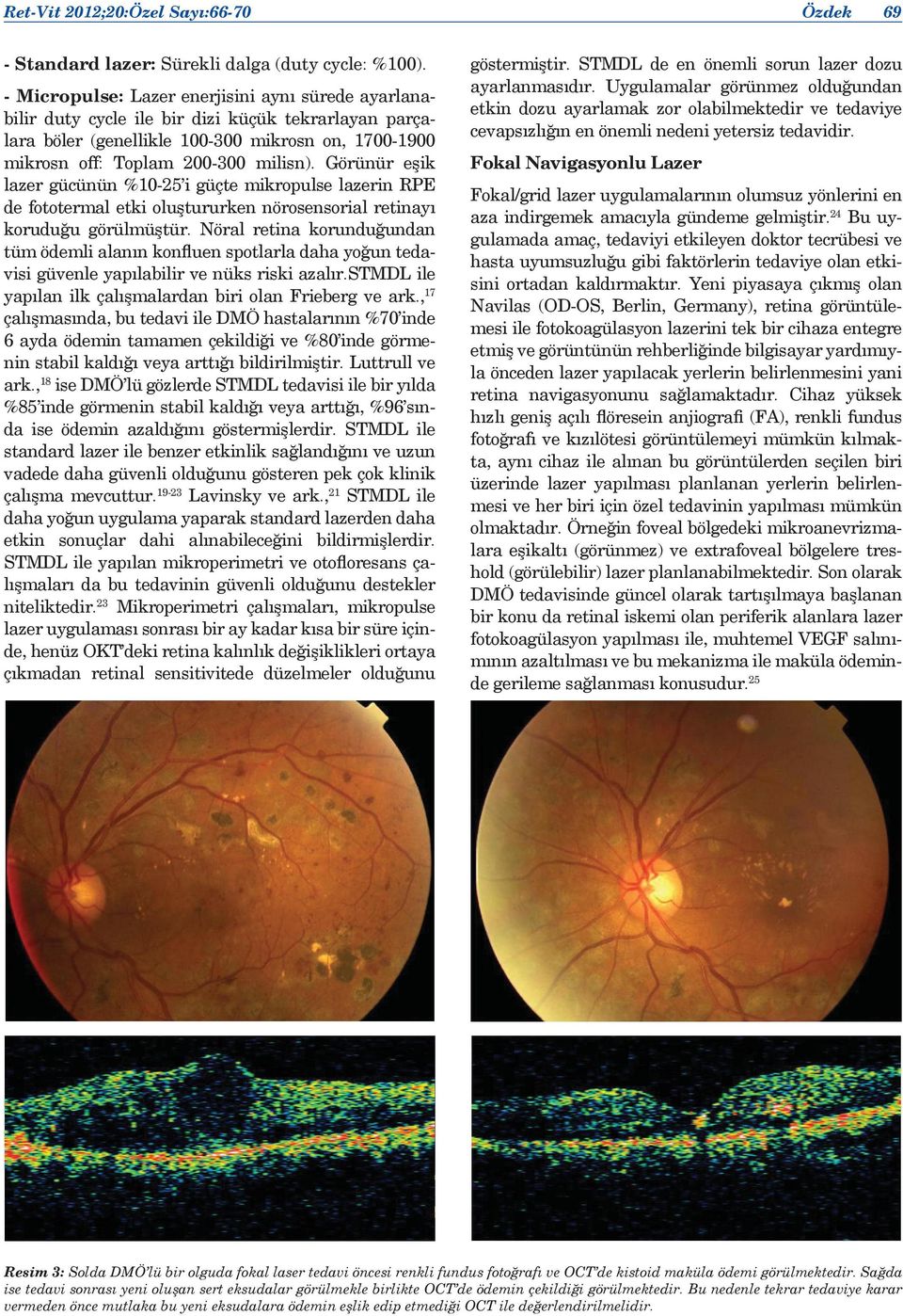 Görünür eşik lazer gücünün %10-25 i güçte mikropulse lazerin RPE de fototermal etki oluştururken nörosensorial retinayı koruduğu görülmüştür.