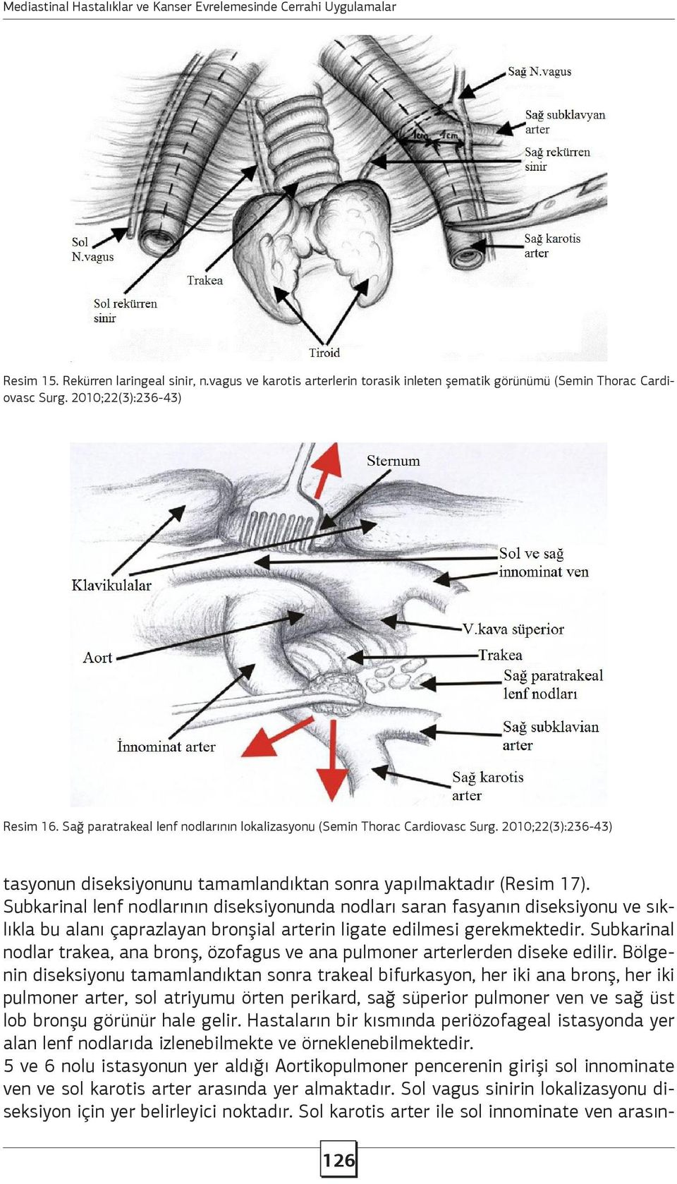 2010;22(3):236-43) tasyonun diseksiyonunu tamamlandıktan sonra yapılmaktadır (Resim 17).