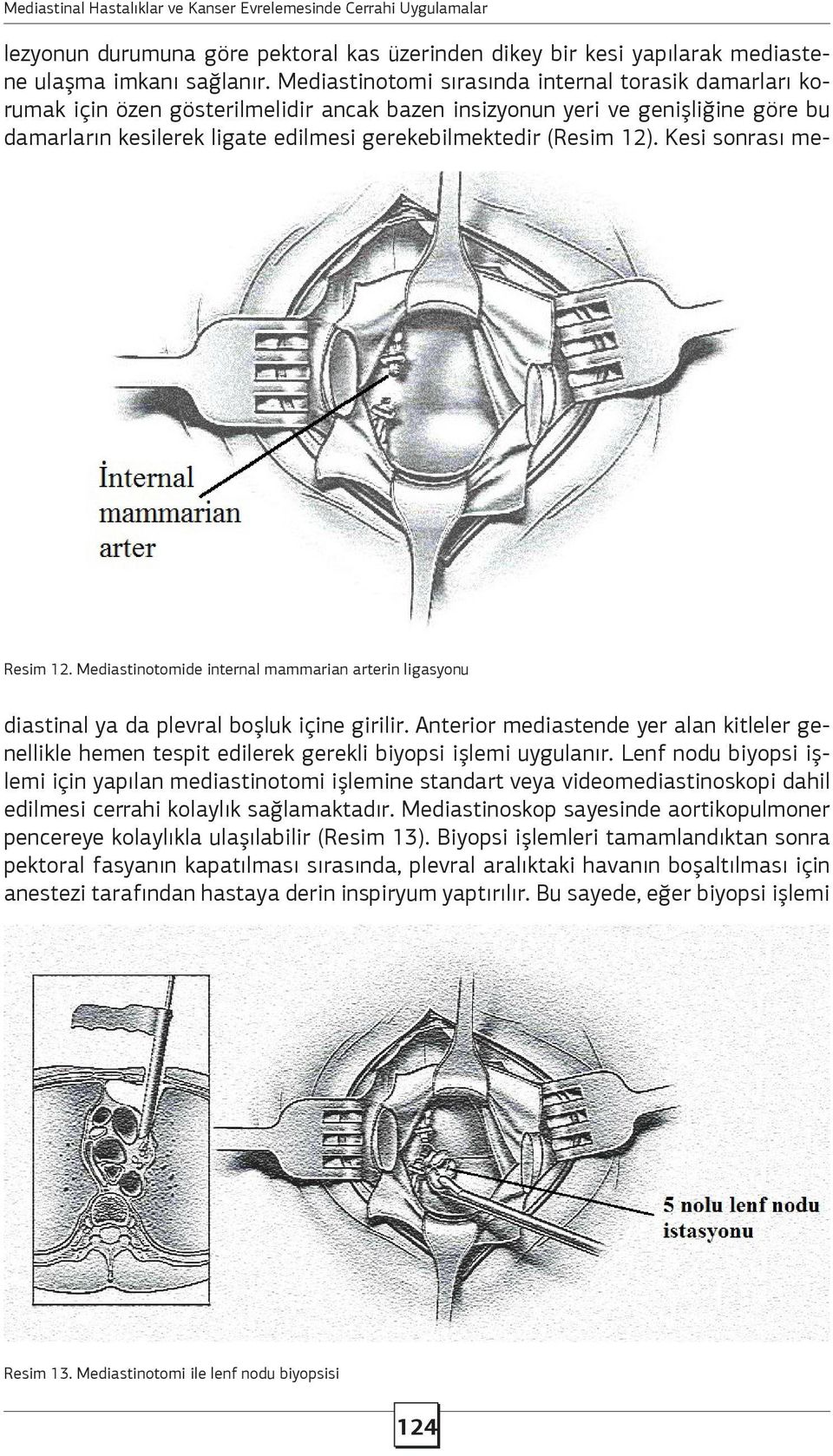 Mediastinotomi sırasında internal torasik damarları korumak için özen gösterilmelidir ancak bazen insizyonun yeri ve genişliğine göre bu damarların kesilerek ligate edilmesi gerekebilmektedir (Resim