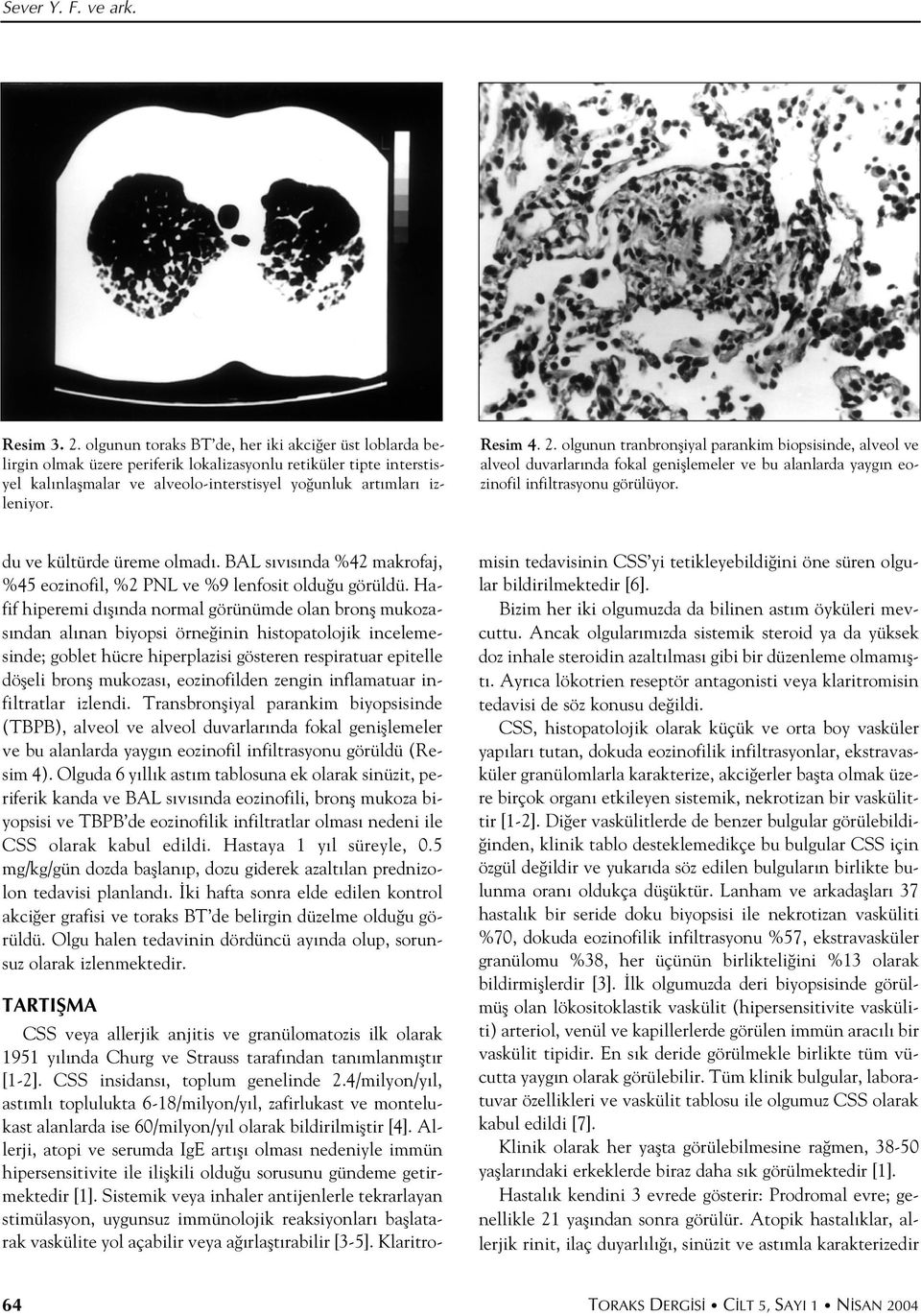 Resim 4. 2. olgunun tranbronfliyal parankim biopsisinde, alveol ve alveol duvarlar nda fokal genifllemeler ve bu alanlarda yayg n eozinofil infiltrasyonu görülüyor. du ve kültürde üreme olmad.