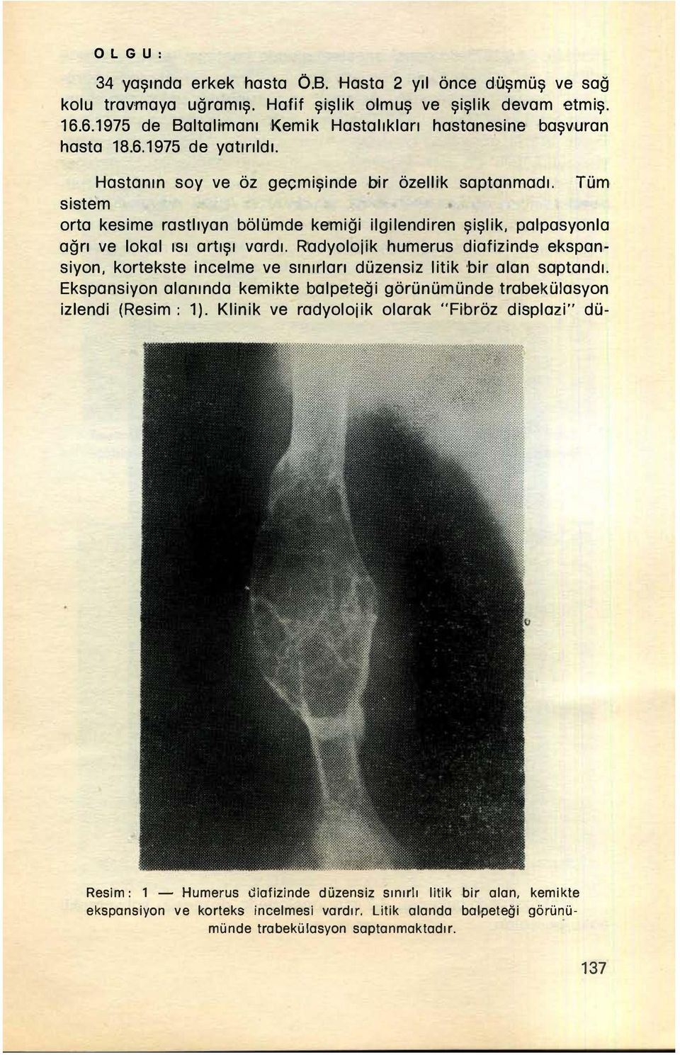 Tüm orta kesime rastlıyon bölümde kemiği ilgilendiren şişlik, palpasyonla ağrı ve lokal ısı artışı vardı.