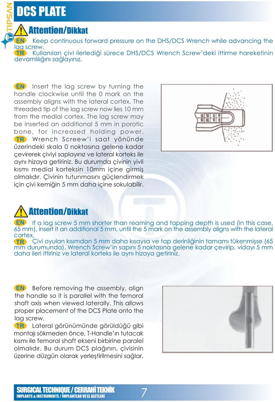 Insert the lag screw by turning the handle clockwise until the 0 mark on the assembly aligns with the lateral cortex. The threaded tip of the lag screw now lies 10 mm from the medial cortex.