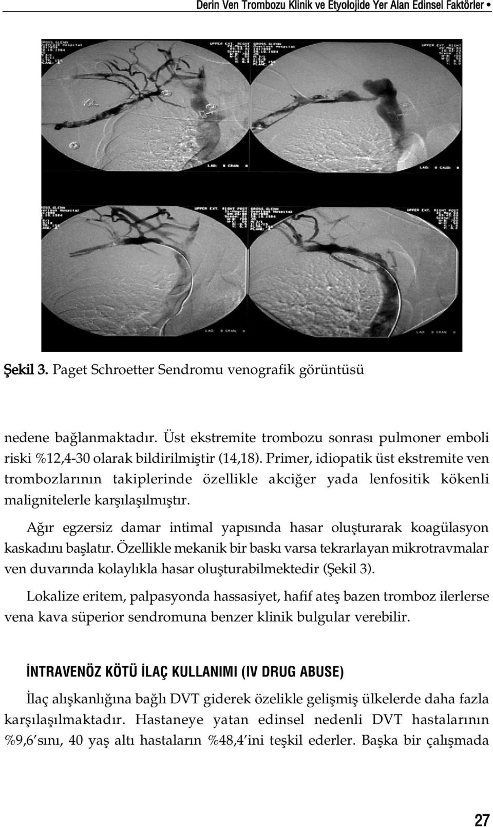 Primer, idiopatik üst ekstremite ven trombozlar n n takiplerinde özellikle akci er yada lenfositik kökenli malignitelerle karfl lafl lm flt r.