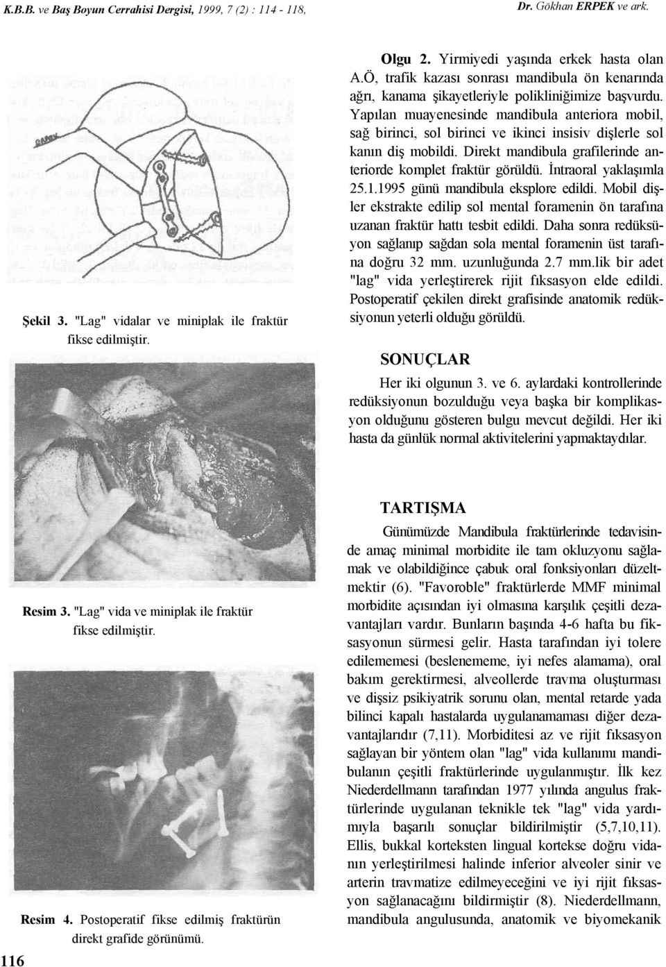 Yapılan muayenesinde mandibula anteriora mobil, sağ birinci, sol birinci ve ikinci insisiv dişlerle sol kanın diş mobildi. Direkt mandibula grafilerinde anteriorde komplet fraktür görüldü.