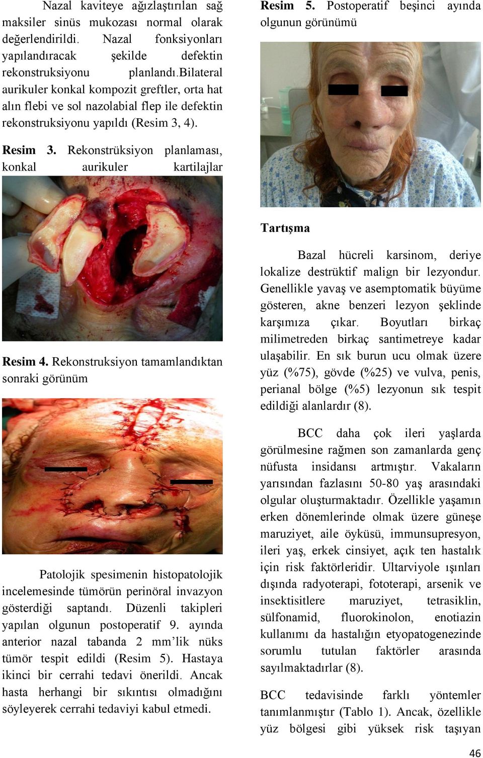 Postoperatif beşinci ayında olgunun görünümü Resim 3. Rekonstrüksiyon planlaması, konkal aurikuler kartilajlar Tartışma Resim 4.