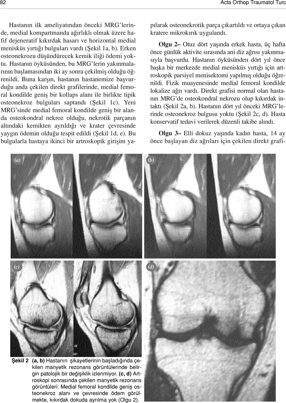 Buna karfl n, hastan n hastanemize baflvurdu u anda çekilen direkt grafilerinde, medial femoral kondilde genifl bir kollaps alan ile birlikte tipik osteonekroz bulgular saptand (fiekil 1c).