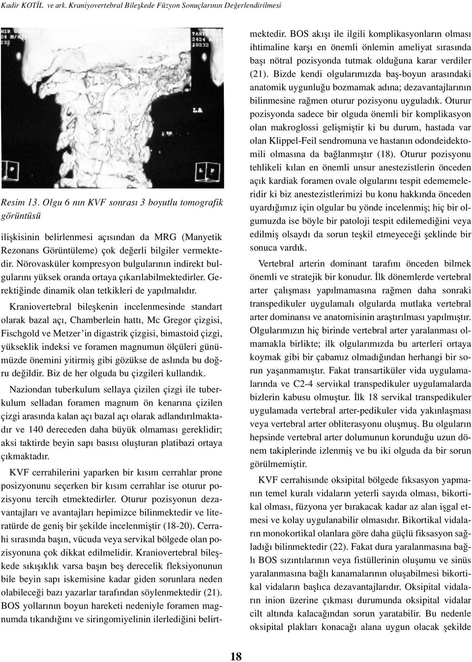 Nörovasküler kompresyon bulgular n n indirekt bulgular n yüksek oranda ortaya ç kar labilmektedirler. Gerekti inde dinamik olan tetkikleri de yap lmal d r.