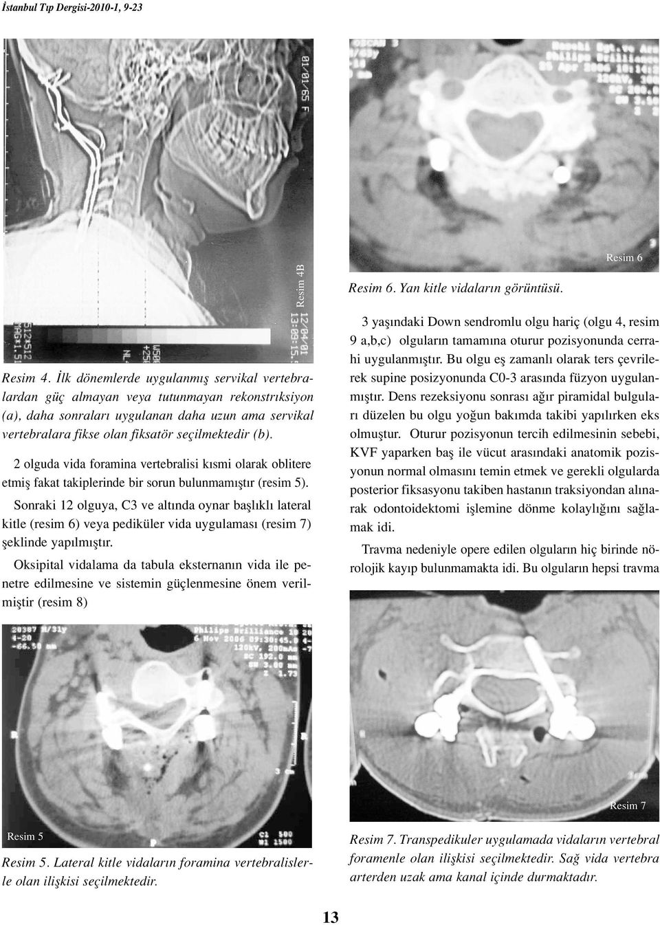 2 olguda vida foramina vertebralisi k smi olarak oblitere etmifl fakat takiplerinde bir sorun bulunmam flt r (resim 5).
