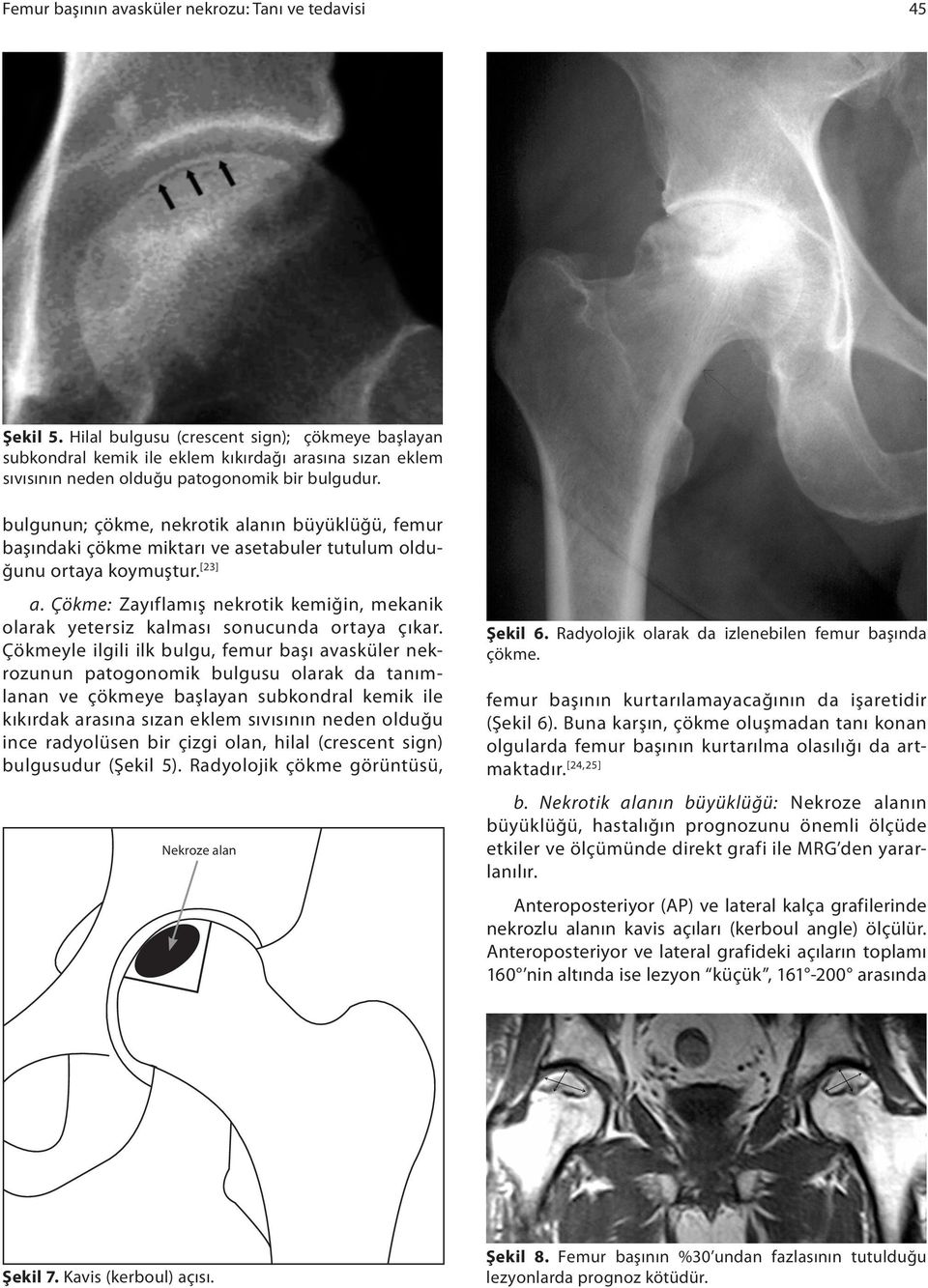 bulgunun; çökme, nekrotik alanın büyüklüğü, femur başındaki çökme miktarı ve asetabuler tutulum olduğunu ortaya koymuştur. [23] a.
