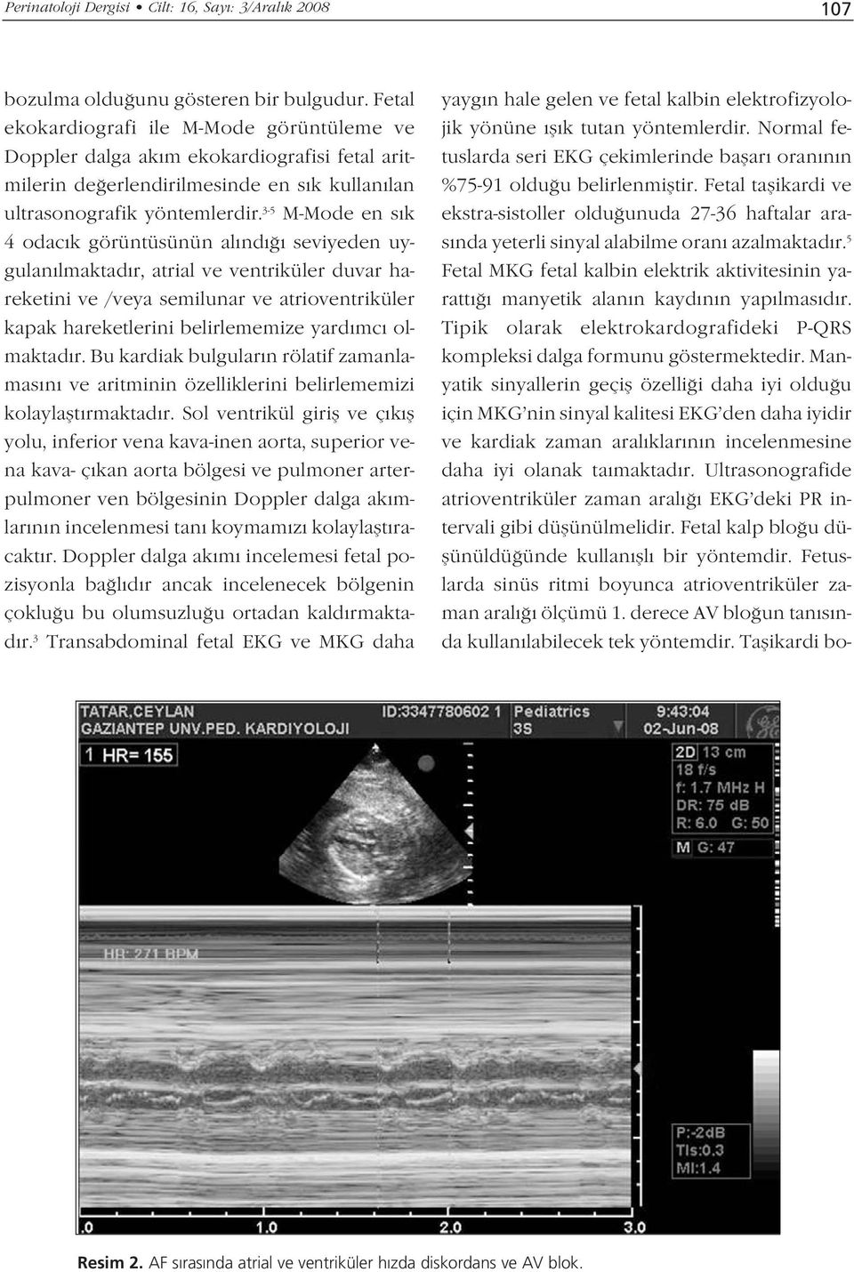 3-5 M-Mode en s k 4 odac k görüntüsünün al nd seviyeden uygulan lmaktad r, atrial ve ventriküler duvar hareketini ve /veya semilunar ve atrioventriküler kapak hareketlerini belirlememize yard mc