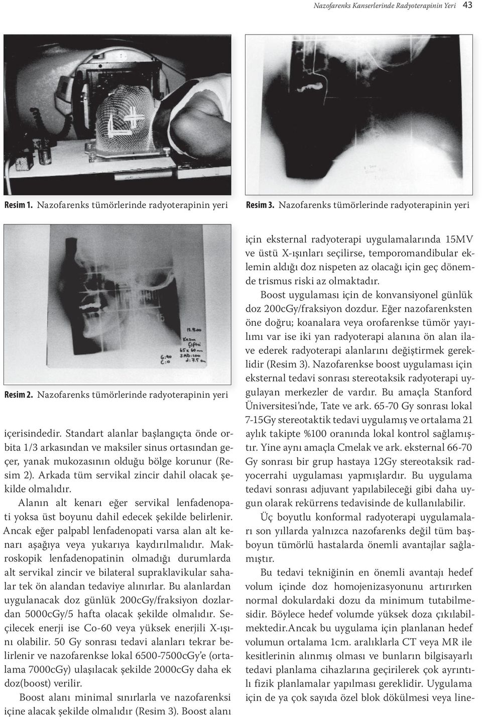 Standart alanlar başlangıçta önde orbita 1/3 arkasından ve maksiler sinus ortasından geçer, yanak mukozasının olduğu bölge korunur (Resim 2). Arkada tüm servikal zincir dahil olacak şekilde olmalıdır.