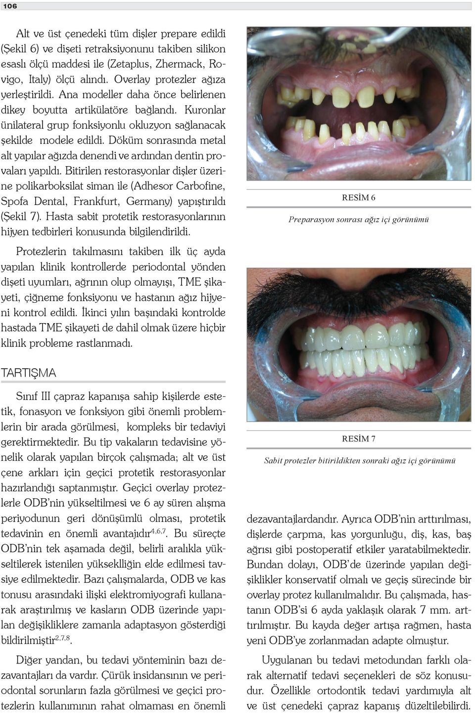 Döküm sonrasında metal alt yapılar ağızda denendi ve ardından dentin provaları yapıldı.