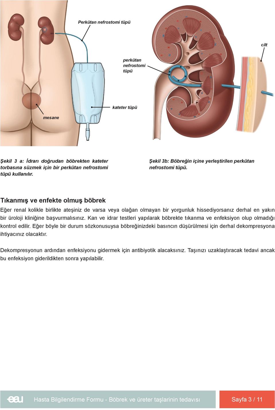 Tıkanmış ve enfekte olmuş böbrek Eğer renal kolikle birlikte ateşiniz de varsa veya olağan olmayan bir yorgunluk hissediyorsanız derhal en yakın bir üroloji kliniğine başvurmalısınız.