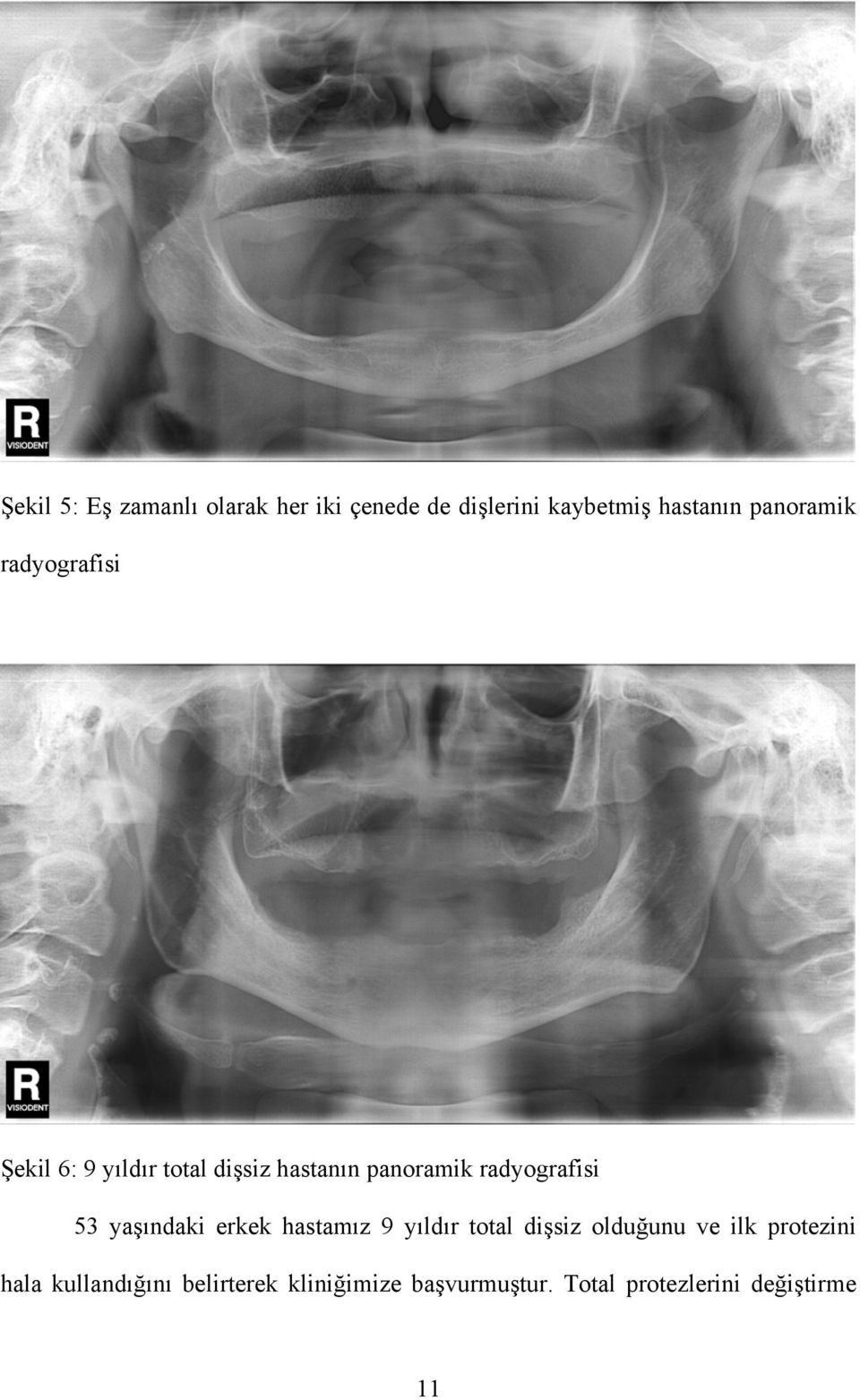 radyografisi 53 yaşındaki erkek hastamız 9 yıldır total dişsiz olduğunu ve ilk