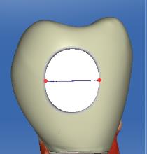 YxG mm; Y okluzogingival konnektör yüksekliğini, G bukkolingual konnektör genişliğini göstermektedir. 3.2. Ana Modellerin Oluşturulması Üç üye köprü modelini oluşturmak amacıyla alt sağ 1.