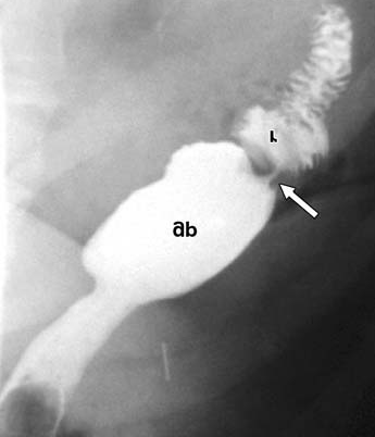 Z. Ünsal Coşkun, Bariyatrik Cerrahi Sonrası Değişen Anatomi ve Komplikasyonların Değerlendirilmesinde Görüntüleme A B C Şekil 6. -en-y bypass sonrası gastrojejunal anastomoz kaçağı. A. Anteroposterior floroskopik görüntüde ekstravaze olan kontrast madde (beyaz oklar) B ve C.