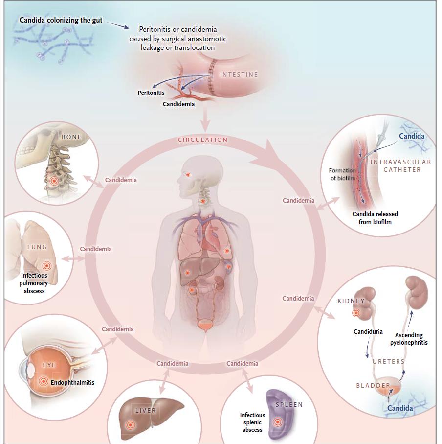 Kandidemi=Endojen Enfeksiyon