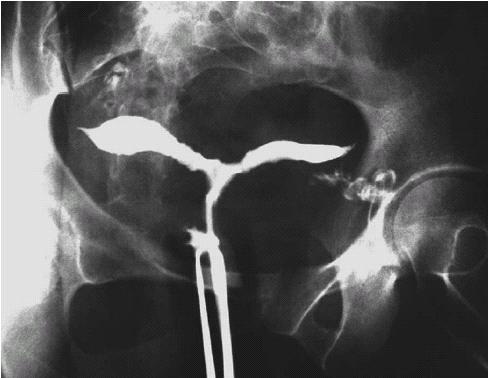 A. Tam Uterus Bicornis 1. Tam longitudinal vaginal septum 2. Kısmı longitudinal vaginal septum 3. Longitudinal vaginal septum yok B.