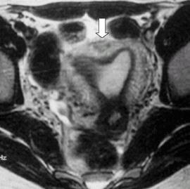 Arcuate Uterus H/L oranı <%10