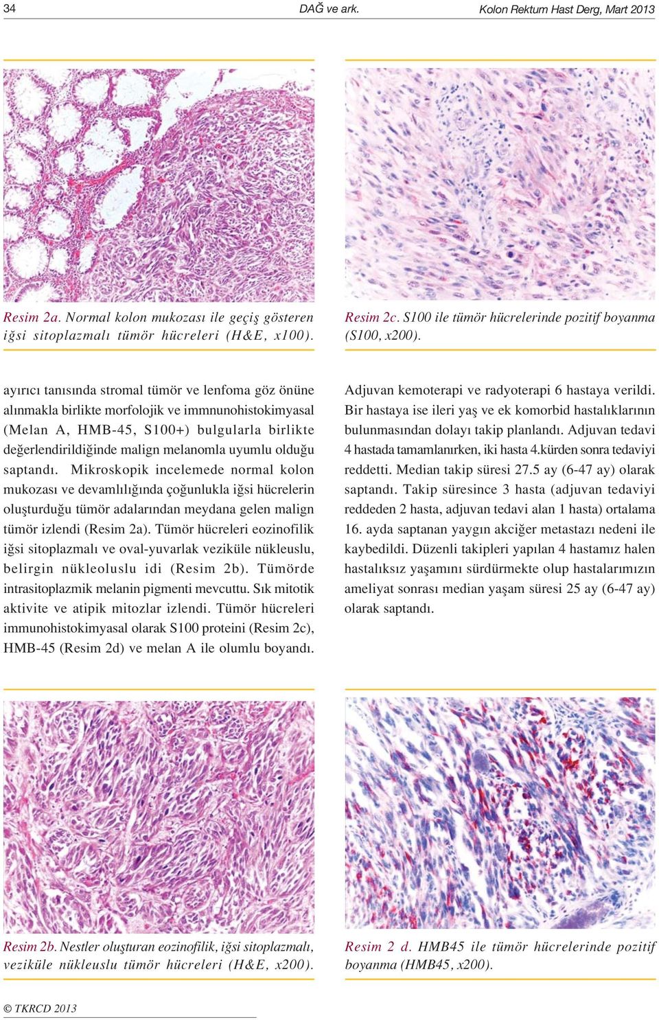 ay r c tan s nda stromal tümör ve lenfoma göz önüne al nmakla birlikte morfolojik ve immnunohistokimyasal (Melan A, HMB-45, S100+) bulgularla birlikte de erlendirildi inde malign melanomla uyumlu