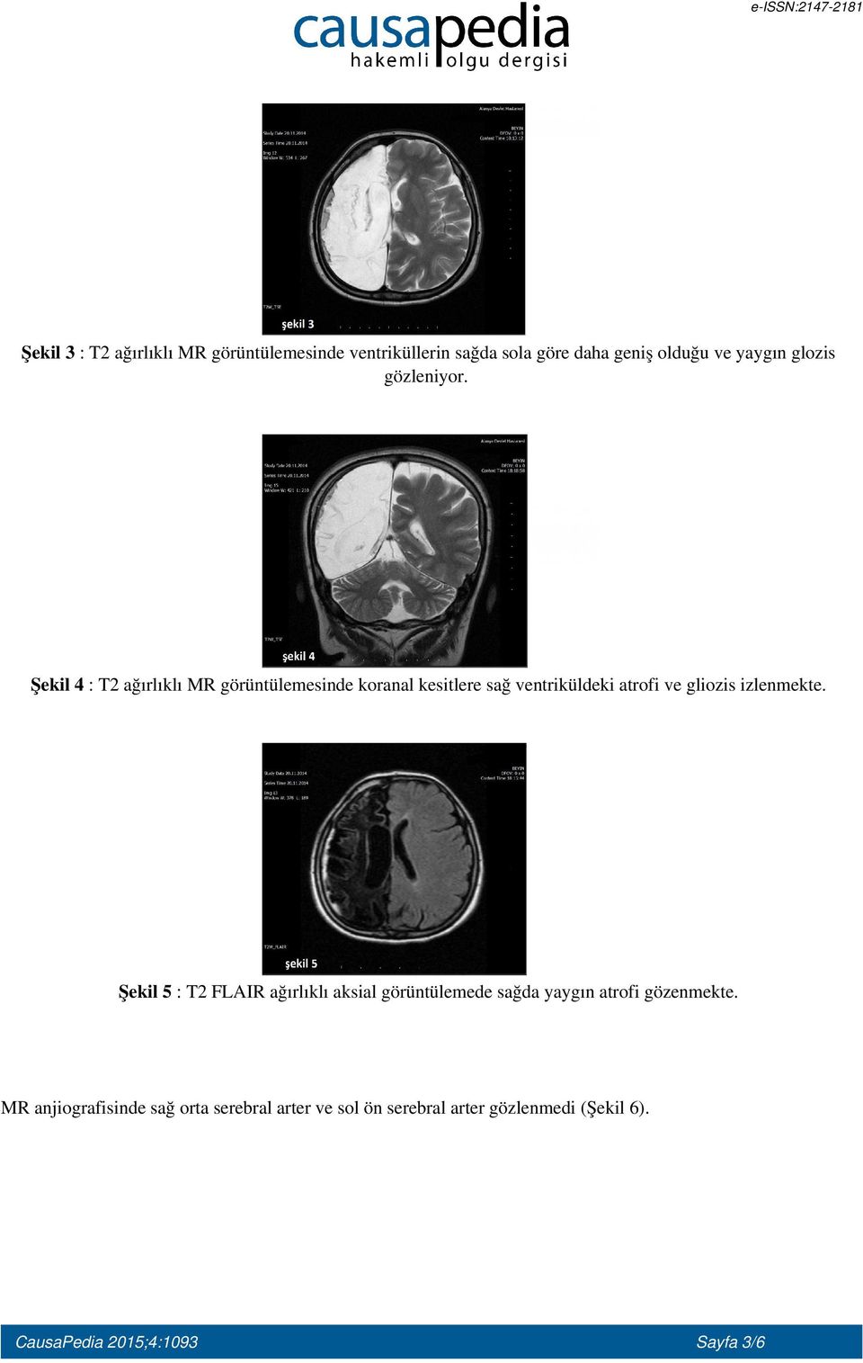 Şekil 4 : T2 ağırlıklı MR görüntülemesinde koranal kesitlere sağ ventriküldeki atrofi ve gliozis