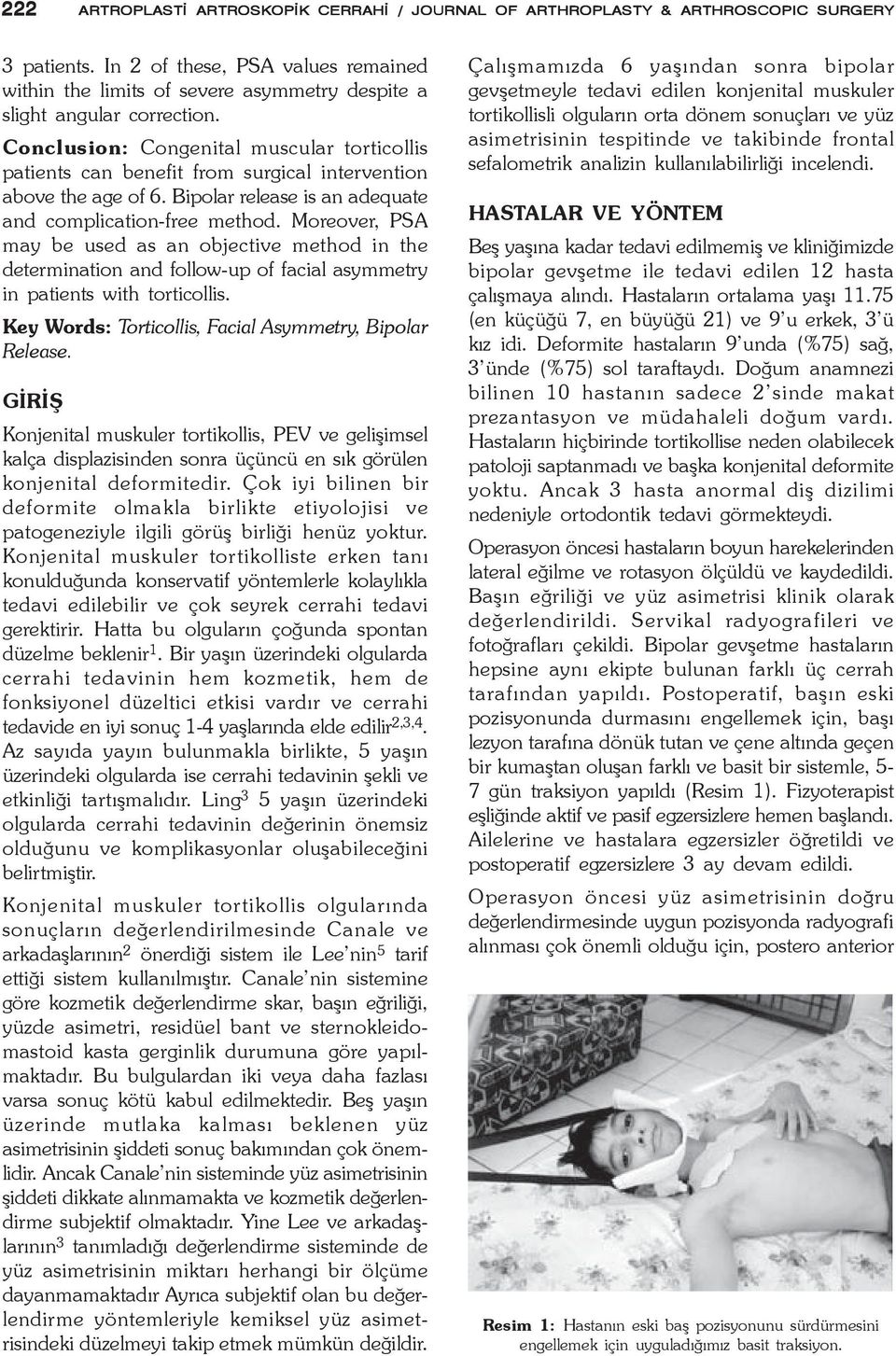 Conclusion: Congenital muscular torticollis patients can benefit from surgical intervention above the age of 6. Bipolar release is an adequate and complication-free method.