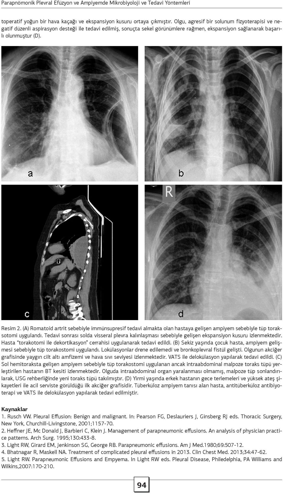 (A) Romatoid artrit sebebiyle immünsupresif tedavi almakta olan hastaya gelişen ampiyem sebebiyle tüp toraksotomi uygulandı.