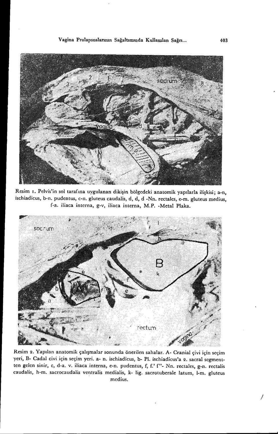 Yapılan anatomik çalışmalar sonunda önerilen sahalar. A- Cranial çivi için seçim yeri, B- Cadal civi için seçim yeri. a- n. ischiadicus, b- PI. ischiadicus'a 2.