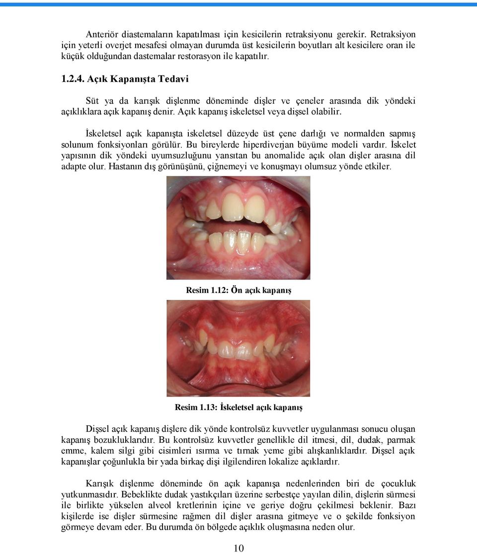 Açık KapanıĢta Tedavi Süt ya da karıģık diģlenme döneminde diģler ve çeneler arasında dik yöndeki açıklıklara açık kapanıģ denir. Açık kapanıģ iskeletsel veya diģsel olabilir.