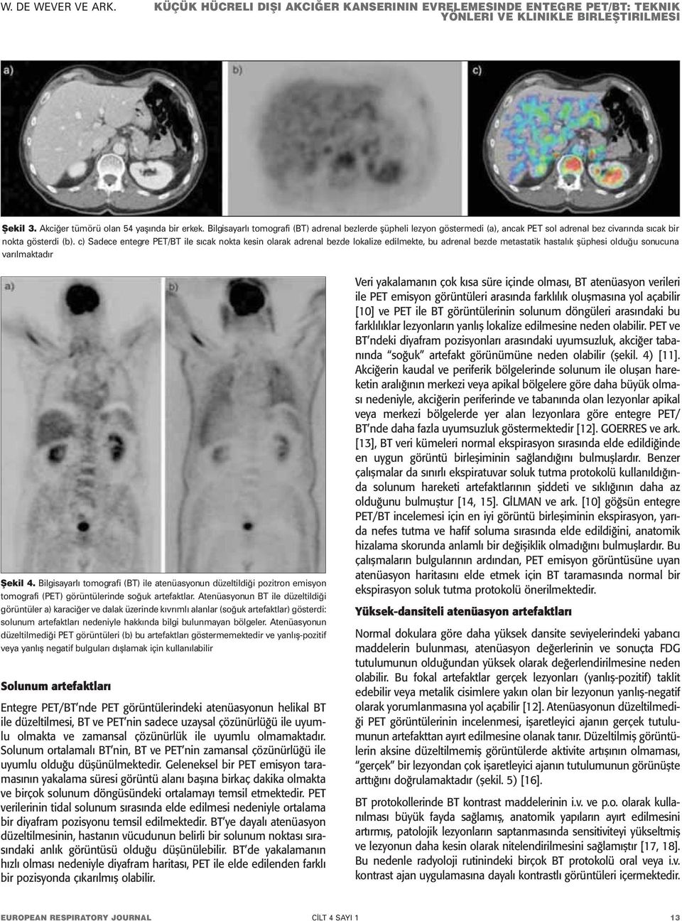 Bilgisayarlı tomografi (BT) ile atenüasyonun düzeltildiği pozitron emisyon tomografi (PET) görüntülerinde soğuk artefaktlar.